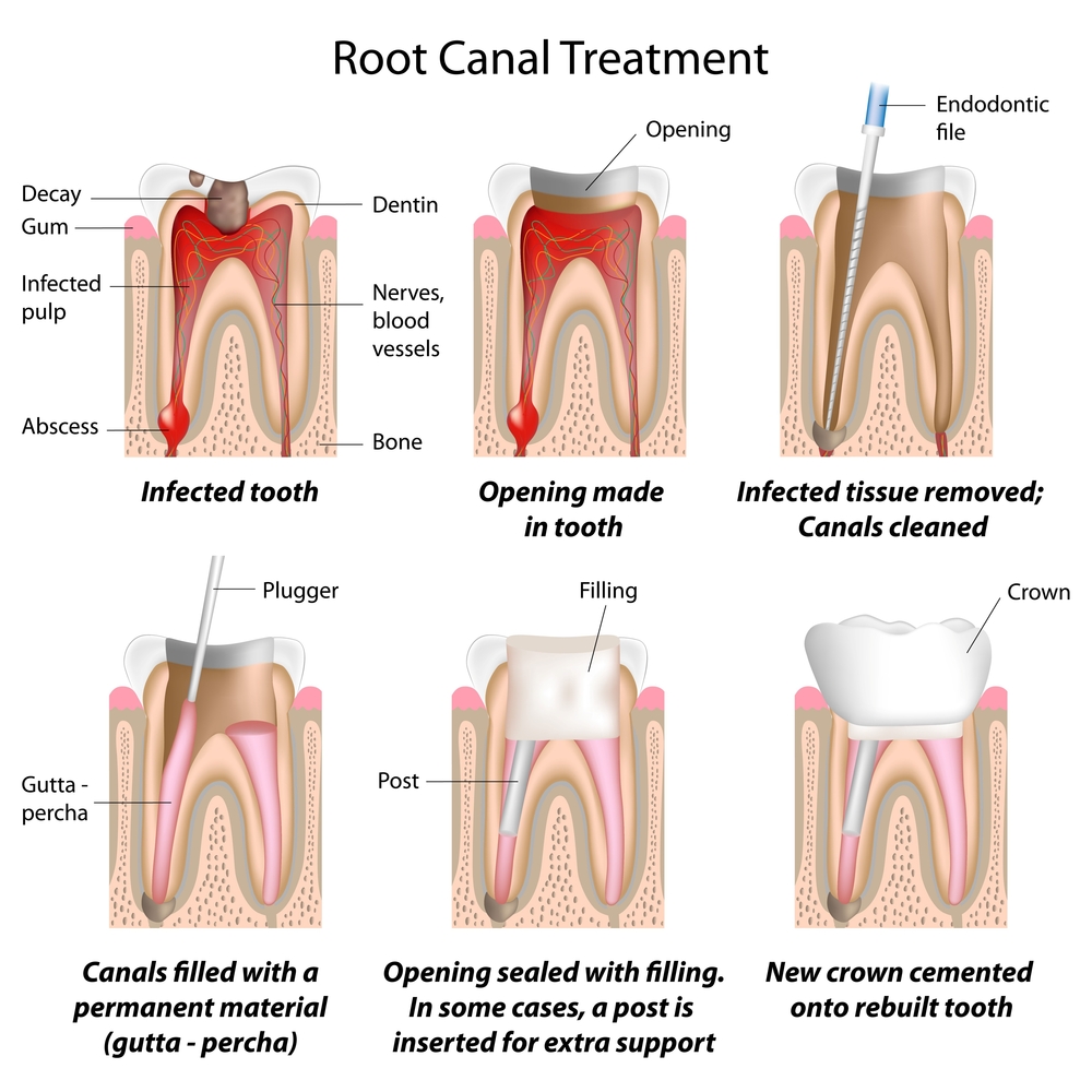 Can You Drive After a Root Canal  