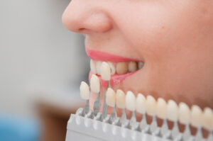 veneers4