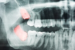 wisdomteeth