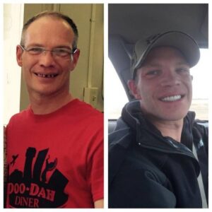 In Mountain View, CA, we can provide the same kind of treatment that Brian Maixner received with dental implants. 