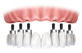 implant-denture